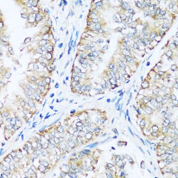 ATP5I Antibody - Immunohistochemistry of paraffin-embedded Human uterine cancer using ATP5I Polyclonal Antibody at dilution of 1:100 (40x lens).