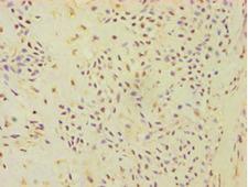ATP5J Antibody - Immunohistochemistry of paraffin-embedded human breast cancer using antibody at 1:100 dilution.