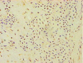 ATP5J Antibody - Immunohistochemistry of paraffin-embedded human breast cancer using ATP5J Antibody at dilution of 1:100