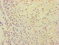 ATP5J Antibody - Immunohistochemistry of paraffin-embedded human breast cancer using antibody at 1:100 dilution.