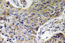 ATP5J2 / F1Fo-ATPase Antibody - Immunohistochemistry analysis of ATP5J2 antibody in paraffin-embedded human lung carcinoma tissue.
