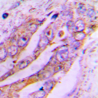 ATP5J2 / F1Fo-ATPase Antibody - Immunohistochemical analysis of ATP5JL staining in human lung cancer formalin fixed paraffin embedded tissue section. The section was pre-treated using heat mediated antigen retrieval with sodium citrate buffer (pH 6.0). The section was then incubated with the antibody at room temperature and detected using an HRP conjugated compact polymer system. DAB was used as the chromogen. The section was then counterstained with hematoxylin and mounted with DPX. w