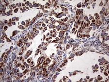 ATP5O Antibody - Immunohistochemical staining of paraffin-embedded Carcinoma of Human lung tissue using anti-ATP5O mouse monoclonal antibody. (Heat-induced epitope retrieval by 1 mM EDTA in 10mM Tris, pH8.5, 120C for 3min,
