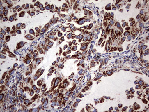 ATP5O Antibody - IHC of paraffin-embedded Carcinoma of Human lung tissue using anti-ATP5O mouse monoclonal antibody. (Heat-induced epitope retrieval by 1 mM EDTA in 10mM Tris, pH8.5, 120°C for 3min).