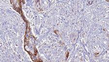 ATP6AP2 / Renin Receptor Antibody - 1:100 staining human urothelial carcinoma tissue by IHC-P. The sample was formaldehyde fixed and a heat mediated antigen retrieval step in citrate buffer was performed. The sample was then blocked and incubated with the antibody for 1.5 hours at 22°C. An HRP conjugated goat anti-rabbit antibody was used as the secondary.