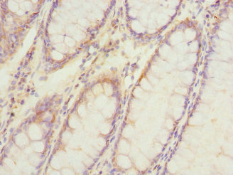ATP6V0A4 Antibody - Immunohistochemistry of paraffin-embedded human colon cancer at dilution 1:100
