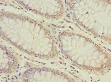 ATP6V0D1 Antibody - Immunohistochemistry of paraffin-embedded human colon cancer at dilution 1:100
