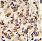 ATP6V1A1 / ATP6V1A Antibody - ATP6V1A Antibody IHC of formalin-fixed and paraffin-embedded breast carcinoma followed by peroxidase-conjugated secondary antibody and DAB staining.