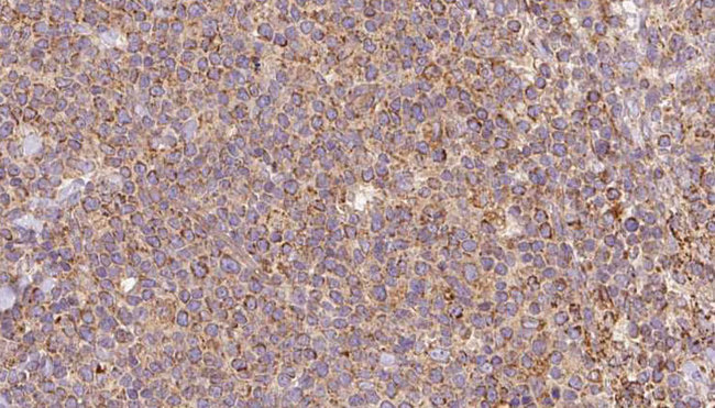 ATP6V1A1 / ATP6V1A Antibody - 1:100 staining human lymph carcinoma tissue by IHC-P. The sample was formaldehyde fixed and a heat mediated antigen retrieval step in citrate buffer was performed. The sample was then blocked and incubated with the antibody for 1.5 hours at 22°C. An HRP conjugated goat anti-rabbit antibody was used as the secondary.