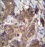 ATP6V1B1 Antibody - ATP6V1B1 Antibody immunohistochemistry of formalin-fixed and paraffin-embedded human breast carcinoma followed by peroxidase-conjugated secondary antibody and DAB staining.