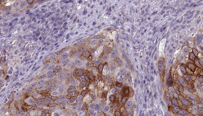 ATP6V1B1 Antibody - 1:100 staining human urothelial carcinoma tissue by IHC-P. The sample was formaldehyde fixed and a heat mediated antigen retrieval step in citrate buffer was performed. The sample was then blocked and incubated with the antibody for 1.5 hours at 22°C. An HRP conjugated goat anti-rabbit antibody was used as the secondary.