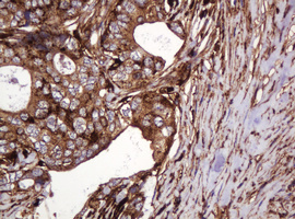 ATP6V1B2 Antibody - IHC of paraffin-embedded Adenocarcinoma of Human breast tissue using anti-ATP6V1B2 mouse monoclonal antibody.