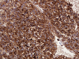 ATP6V1B2 Antibody - IHC of paraffin-embedded Carcinoma of Human liver tissue using anti-ATP6V1B2 mouse monoclonal antibody.