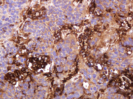 ATP6V1B2 Antibody - IHC of paraffin-embedded Carcinoma of Human lung tissue using anti-ATP6V1B2 mouse monoclonal antibody.
