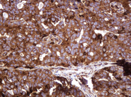ATP6V1B2 Antibody - IHC of paraffin-embedded Adenocarcinoma of Human ovary tissue using anti-ATP6V1B2 mouse monoclonal antibody.