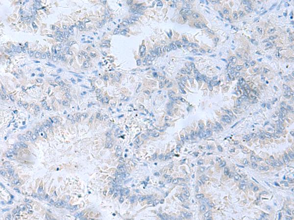 ATP6V1C1 Antibody - Immunohistochemistry of paraffin-embedded Human lung cancer tissue  using ATP6V1C1 Polyclonal Antibody at dilution of 1:100(×200)