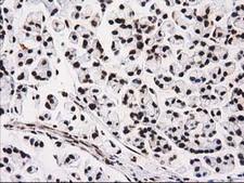 ATP6V1F Antibody - IHC of paraffin-embedded Adenocarcinoma of Human colon tissue using anti-ATP6V1F mouse monoclonal antibody. (Heat-induced epitope retrieval by 10mM citric buffer, pH6.0, 100C for 10min).