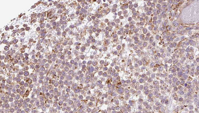 ATP8A1 Antibody - 1:100 staining human lymph carcinoma tissue by IHC-P. The sample was formaldehyde fixed and a heat mediated antigen retrieval step in citrate buffer was performed. The sample was then blocked and incubated with the antibody for 1.5 hours at 22°C. An HRP conjugated goat anti-rabbit antibody was used as the secondary.