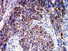 ATPIF1 / ATPI Antibody - Immunohistochemical analysis of paraffin-embedded cervical cancer tissues using ATPIF1 mouse mAb with DAB staining.