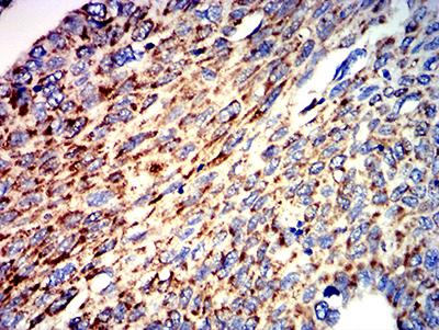 ATPIF1 / ATPI Antibody - Immunohistochemical analysis of paraffin-embedded lung cancer tissues using ATPIF1 mouse mAb with DAB staining.