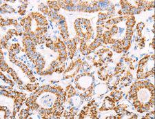 ATPIF1 / ATPI Antibody - Immunohistochemistry of paraffin-embedded Human thyroid cancer using ATPIF1 Polyclonal Antibody at dilution of 1:50.