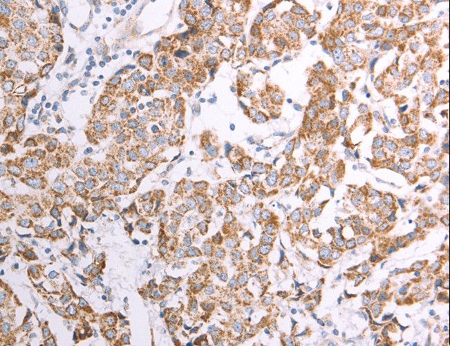 ATPIF1 / ATPI Antibody - Immunohistochemistry of paraffin-embedded Human breast cancer using ATPIF1 Polyclonal Antibody at dilution of 1:50.