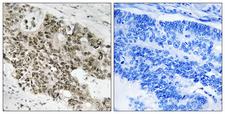 ATR Antibody - Immunohistochemistry analysis of paraffin-embedded human colon carcinoma, using ATR Antibody. The picture on the right is blocked with the synthesized peptide.