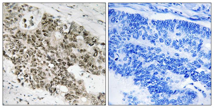 ATR Antibody - Peptide - + Immunohistochemistry analysis of paraffin-embedded human colon carcinoma tissue using ATR antibody.