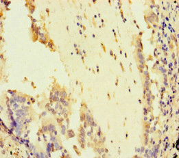 ATR Antibody - Immunohistochemistry of paraffin-embedded human lung cancer at dilution of 1:100