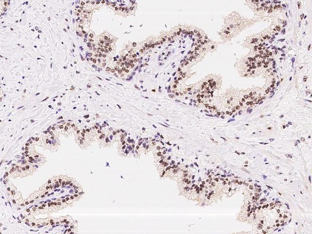 ATR Antibody - Immunochemical staining ATR in human prostate with rabbit polyclonal antibody at 1:200 dilution, formalin-fixed paraffin embedded sections.