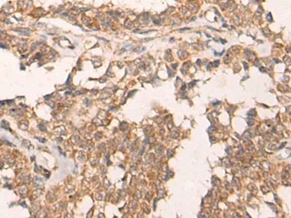 ATR Antibody - Immunohistochemistry of paraffin-embedded Human ovarian cancer tissue  using ATR Polyclonal Antibody at dilution of 1:60(×200)