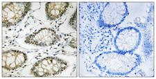 ATR Antibody - Immunohistochemistry analysis of paraffin-embedded human colon carcinoma, using ATR (Phospho-Ser428) Antibody. The picture on the right is blocked with the phospho peptide.