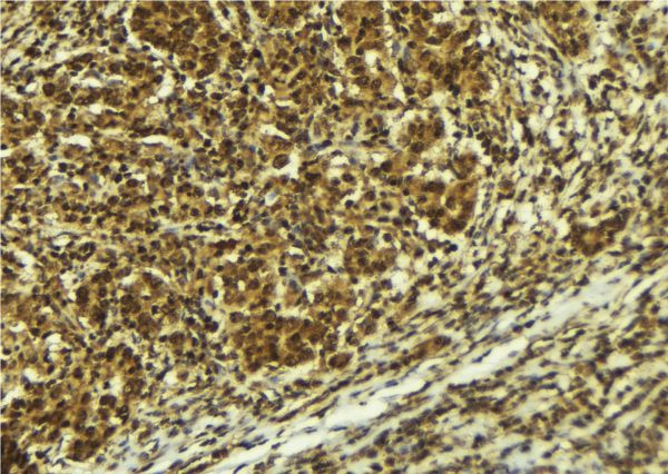 ATR Antibody - 1:100 staining human breast carcinoma tissue by IHC-P. The sample was formaldehyde fixed and a heat mediated antigen retrieval step in citrate buffer was performed. The sample was then blocked and incubated with the antibody for 1.5 hours at 22°C. An HRP conjugated goat anti-rabbit antibody was used as the secondary.