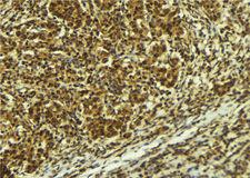 ATR Antibody - 1:100 staining human breast carcinoma tissue by IHC-P. The sample was formaldehyde fixed and a heat mediated antigen retrieval step in citrate buffer was performed. The sample was then blocked and incubated with the antibody for 1.5 hours at 22°C. An HRP conjugated goat anti-rabbit antibody was used as the secondary.