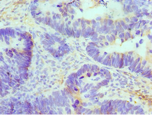 ATRIP Antibody - Immunohistochemistry of paraffin-embedded human ovarian cancer using ATRIP Antibody at dilution of 1:100