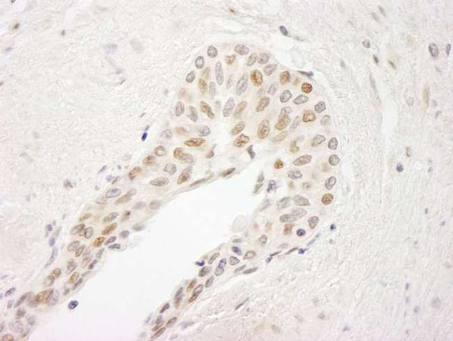 ATRIP Antibody - Detection of Human ATRIP by Immunohistochemistry. Sample: FFPE section of human prostate carcinoma. Antibody: Affinity purified rabbit anti-ATRIP used at a dilution of 1:250.
