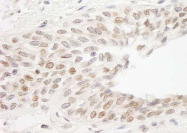 ATRIP Antibody - Detection of Human ATRIP by Immunohistochemistry. Sample: FFPE section of human prostate carcinoma. Antibody: Affinity purified rabbit anti-ATRIP used at a dilution of 1:1000 (1 ug/ml).