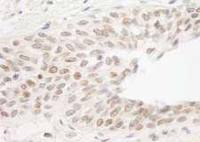 ATRIP Antibody - Detection of Human ATRIP by Immunohistochemistry. Sample: FFPE section of human prostate carcinoma. Antibody: Affinity purified rabbit anti-ATRIP used at a dilution of 1:1000 (1 ug/ml).