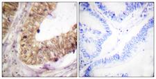 ATRIP Antibody - Immunohistochemistry analysis of paraffin-embedded human colon carcinoma tissue, using ATRIP Antibody. The picture on the right is blocked with the synthesized peptide.