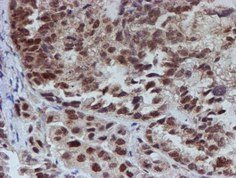 ATRIP Antibody - IHC of paraffin-embedded Adenocarcinoma of Human ovary tissue using anti-ATRIP mouse monoclonal antibody.