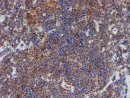 ATRIP Antibody - IHC of paraffin-embedded Human lymphoma tissue using anti-ATRIP mouse monoclonal antibody.