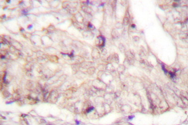ATRIP Antibody - IHC of ATRIP (D64) pAb in paraffin-embedded human lung colon carcinoma tissue.
