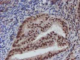 ATRIP Antibody - IHC of paraffin-embedded Adenocarcinoma of Human endometrium tissue using anti-ATRIP mouse monoclonal antibody.