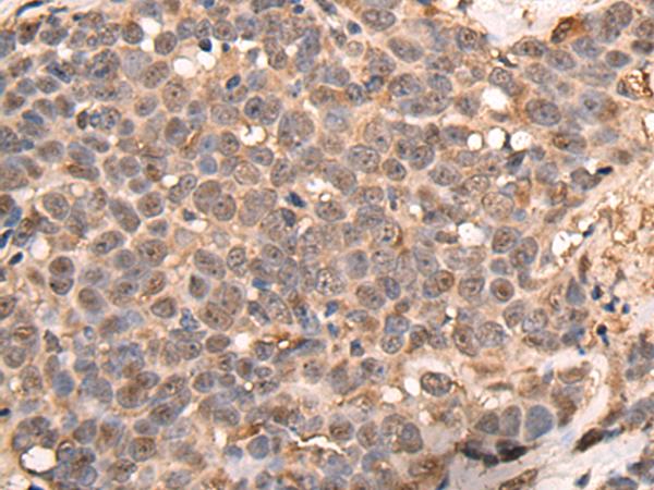 ATRIP Antibody - Immunohistochemistry of paraffin-embedded Human thyroid cancer tissue  using ATRIP Polyclonal Antibody at dilution of 1:40(×200)