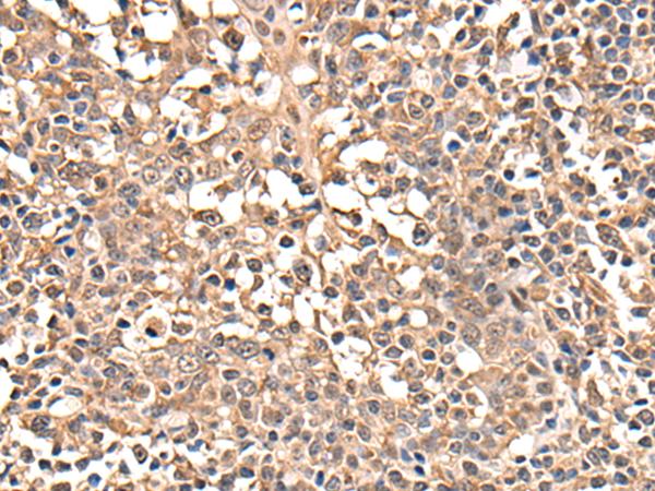 ATRIP Antibody - Immunohistochemistry of paraffin-embedded Human tonsil tissue  using ATRIP Polyclonal Antibody at dilution of 1:40(×200)