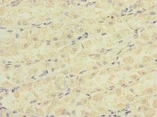 ATRN / Attractin Antibody - Immunohistochemistry of paraffin-embedded human gastric cancer at dilution 1:100