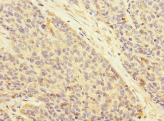 ATRN / Attractin Antibody - Immunohistochemistry of paraffin-embedded human ovarian cancer at dilution 1:100