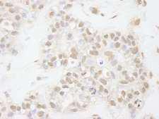 ATRX Antibody - Detection of Human ATRX by Immunohistochemistry. Sample: FFPE section of human breast carcinoma. Antibody: Affinity purified rabbit anti-ATRX used at a dilution of 1:250.