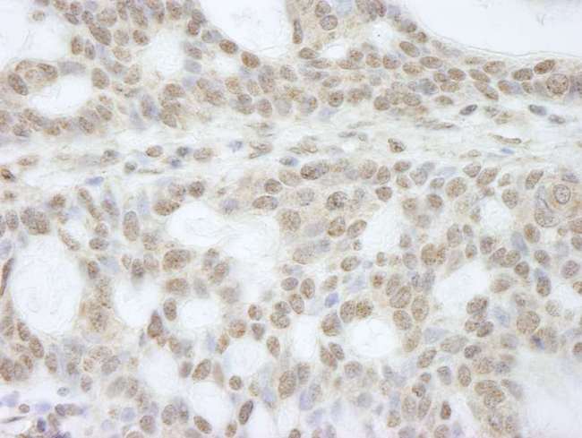 ATRX Antibody - Detection of Human ATRX by Immunohistochemistry. Sample: FFPE section of human basal cell carcinoma. Antibody: Affinity purified rabbit anti-ATRX used at a dilution of 1:250.