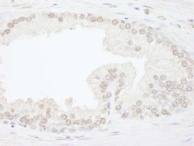 ATRX Antibody - Detection of Human ATRX by Immunohistochemistry. Sample: FFPE section of human prostate carcinoma. Antibody: Affinity purified rabbit anti-ATRX used at a dilution of 1:1000 (1 ug/ml).